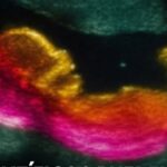 6 signs of colon cancer you should not overlook… See more