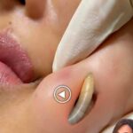 BE CAREFUL, if you get these bruises on your body, it means you have Ca…see more